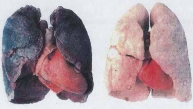 De nombreux alcooliques chroniques meurent de lésions pulmonaires (à gauche)