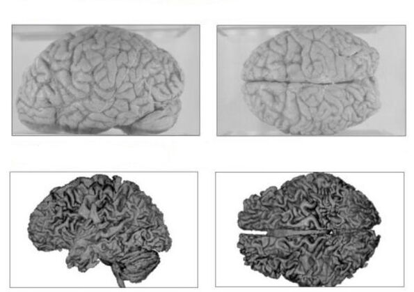 Le cerveau d'une personne en bonne santé (ci-dessus) et le cerveau d'un alcoolique aux conséquences irréversibles (ci-dessous)
